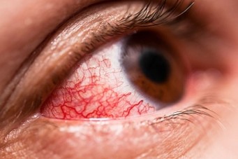 Zica vírus também pode desencadear problemas oftalmológicos