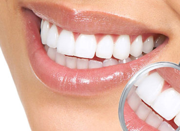 ‘Lente de contato’ para dente garante sorriso sem imperfeições