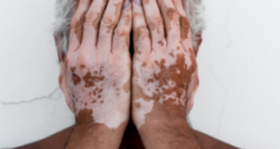 Conheça os tipos de vitiligo e os tratamentos para a doença