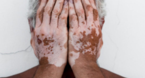 Conheça os tipos de vitiligo e os tratamentos para a doença