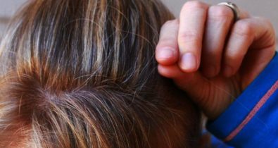 Arrancar fios de cabelo pode ser sinal de distúrbio