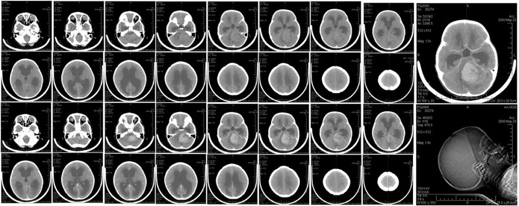 Vírus zika pode eliminar tumor cerebral comum em crianças