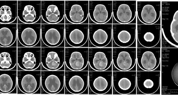 Vírus zika pode eliminar tumor cerebral comum em crianças