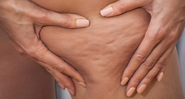 Quatro dicas para prevenir e tratar a celulite