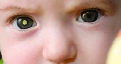 Retinoblastoma: saiba como identificar o câncer ocular mais comum em crianças