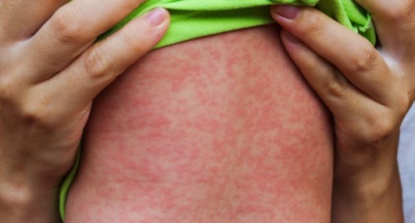 Surto de Sarampo em Amazonas e Roraima acende alerta sobre a doença