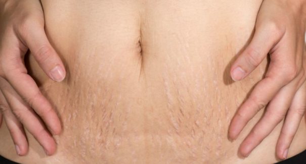 Sofre com estrias? Especialista dá dicas de como tratar e prevenir