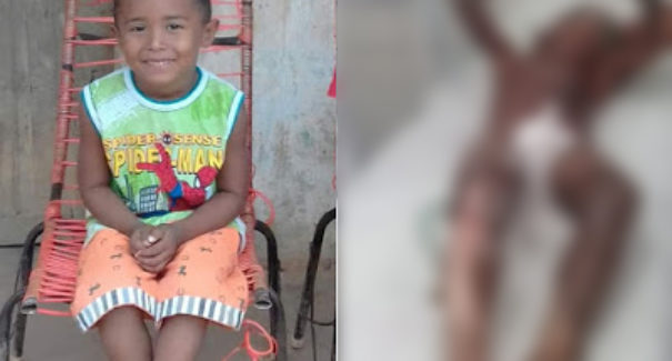 Criança é internada após ter corpo queimado em carvoaria
