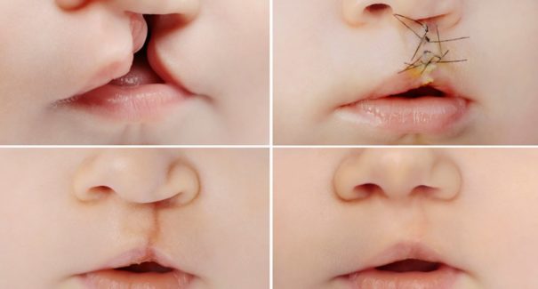 Projeto garante tratamento no SUS para criança com fissura labiopalatal