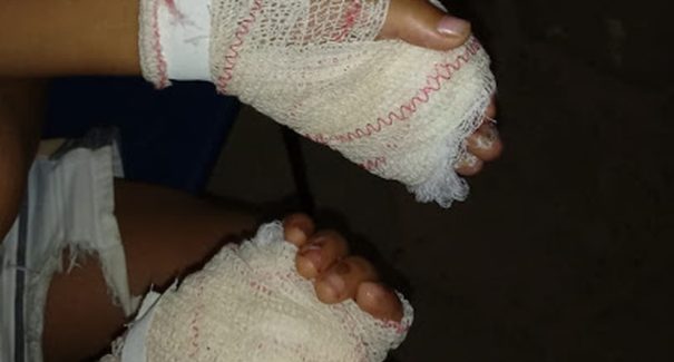Mãe é presa acusada de queimar as mãos do filho de quatro anos