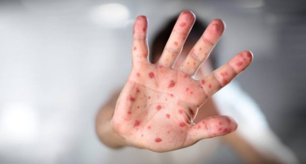 Sarampo: veja os sintomas, prevenção, complicações e tratamento