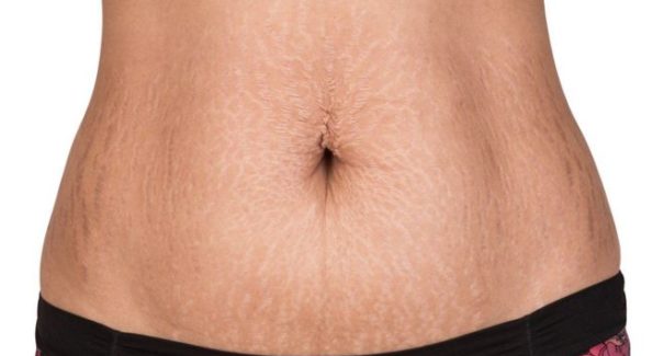 5 dicas para amenizar as marcas de estrias