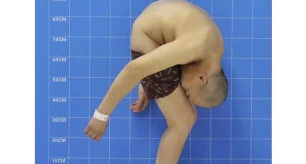Cirurgia ‘conserta’ coluna de chinês que vivia com ‘rosto nas coxas’