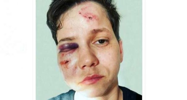 Apoiadora de Bolsonaro é agredida em ataque homofóbico