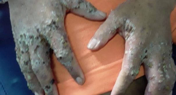 Bactéria desconhecida está deformando corpos de presos em penitenciária