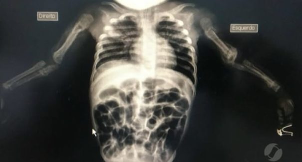 Bebê vítima de espancamento morre em Goiânia