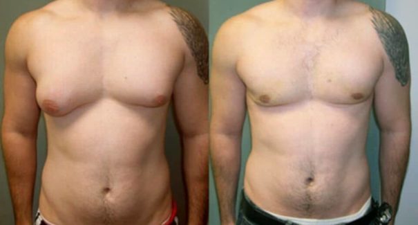 Ginecomastia: Seios em homens afeta mais de 150 mil por ano