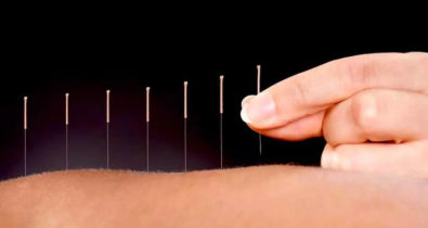 Conheça 5 grandes benefícios da acupuntura