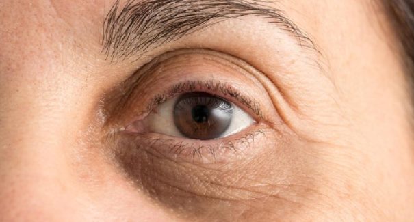 4 dicas de tratamentos naturais para reduzir olheiras