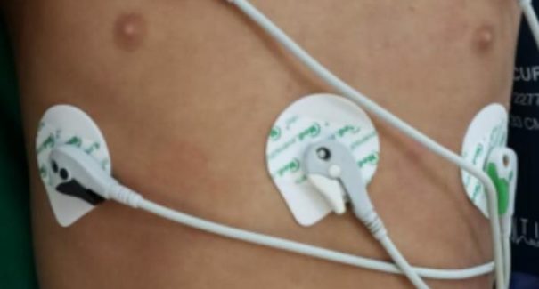 Médicos do Maranhão investigam possível relação entre doença inflamatória infantil e a Covid-19