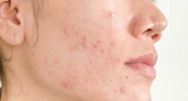 Como evitar espinhas durante a TPM com skincare e receitas caseiras