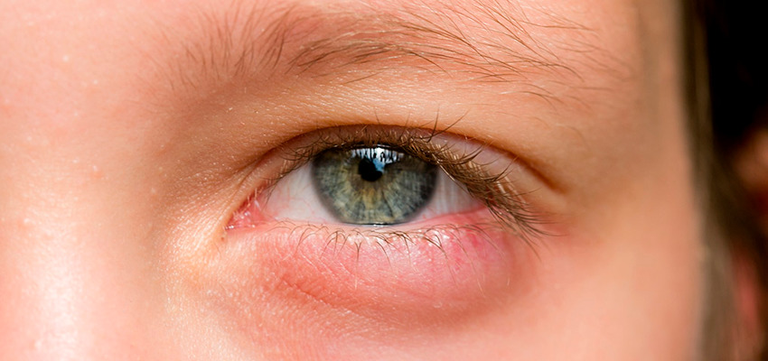 3 formas de tratamento para o terçol – Hospital de Olhos