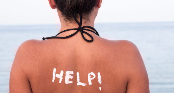 Pós-feriado: Como aliviar queimaduras de Sol?
