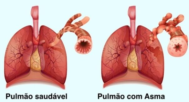 Asma mata de 3 a 6 pessoas por dia