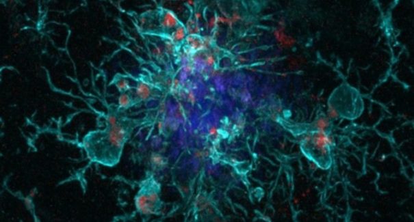 Covid-19 pode acelerar doença de Alzheimer, revela novo estudo
