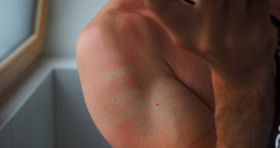 População masculina tem maior número de casos de câncer de pele, aponta SBD
