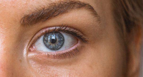 O que é e como prevenir o melasma