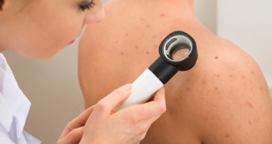 Câncer de pele é o tipo mais comum de câncer no Brasil