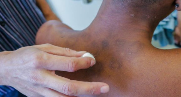 Pandemia de covid-19 faz notificações de hanseníase caírem 57% em 2021
