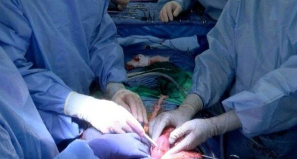 Rins de porco são transplantados em paciente com morte cerebral