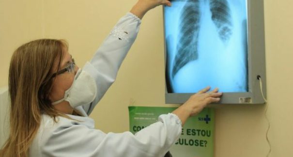 Mais de 3 mil casos de tuberculose em 2021 foram registrados no Maranhão
