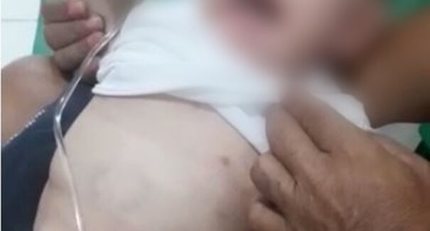 Bebê é internado com marcas de mordida e costelas quebradas; pais foram presos suspeitos de maus tratos