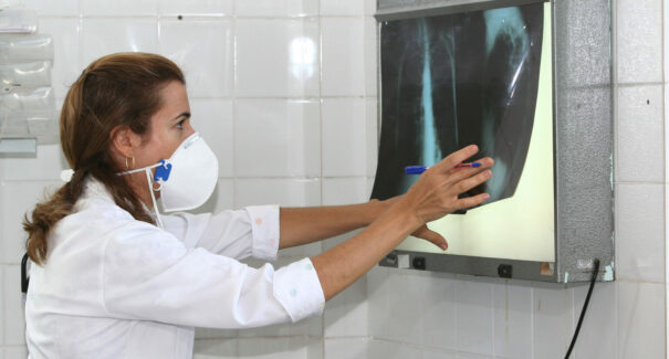 Mais de 3 mil casos de tuberculose em 2021 foram registrados no Maranhão