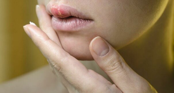 Entre 13% e 37% das pessoas infectadas pelo herpes apresentam sintomas