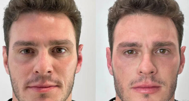 Após Stênio Garcia, ex-BBB Gustavo Cowboy realiza harmonização facial