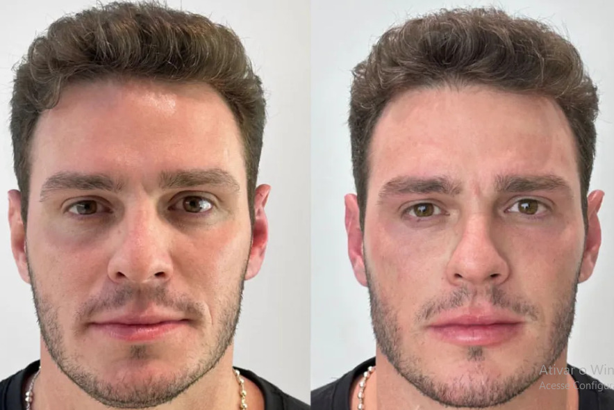 Harmonização facial: procedimento de Fred Nicácio, do BBB23, pode