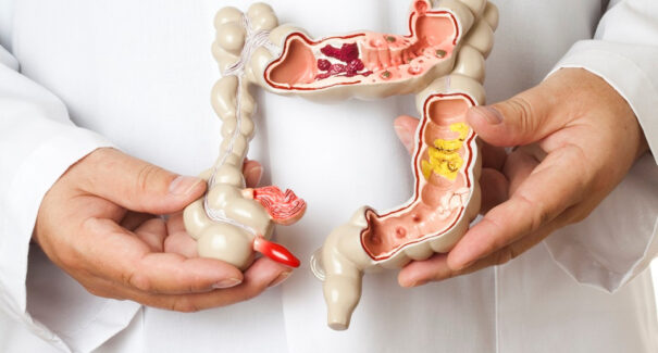 Câncer colorretal: exame de colonoscopia é essencial para o diagnóstico das doenças do intestino