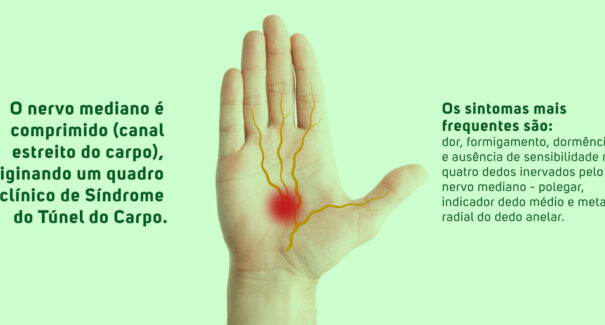 Síndrome do Túnel do Carpo: dores nas mãos merecem atenção, alerta especialista