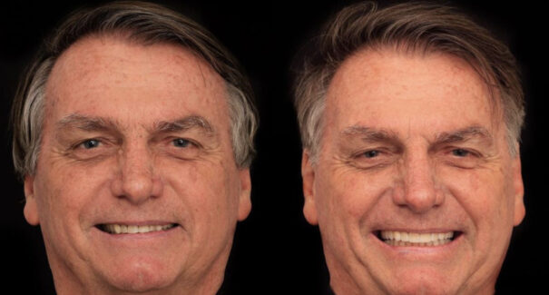 Bolsonaro faz harmonização orofacial em meio a escândalo de joias e investigação da PF