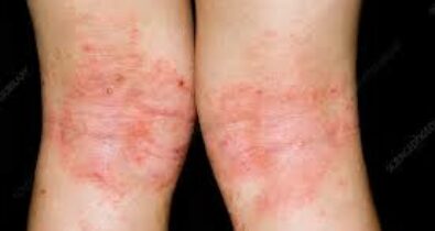Dermatite atópica: conheça os sintomas e as formas de tratamento