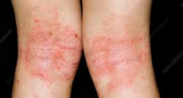 Dermatite atópica: conheça os sintomas e as formas de tratamento