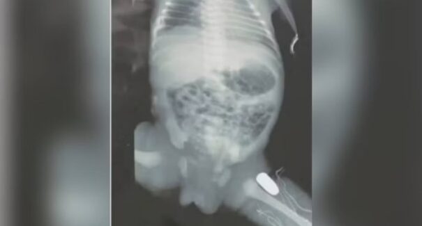 Adolescente grávida é baleada durante assalto e bala fica alojada no bebê