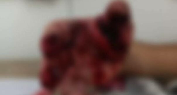 Adolescente tem mão dilacerada após explosão de bomba de São João em Codó