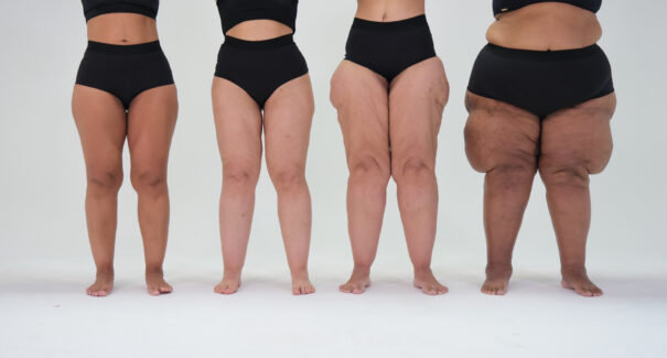 Novo estudo aponta exercício físico como terapia para aliviar sintomas do lipedema