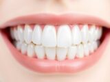 Whiteness Perfect 22%:  Clareamento Dental Caseiro Perfeito