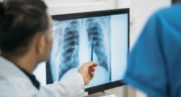 Maranhão registra quase 13 mil casos de tuberculose em 5 anos